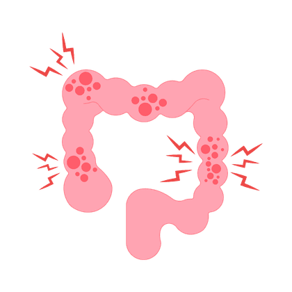 Irritable bowel syndrome (IBS)