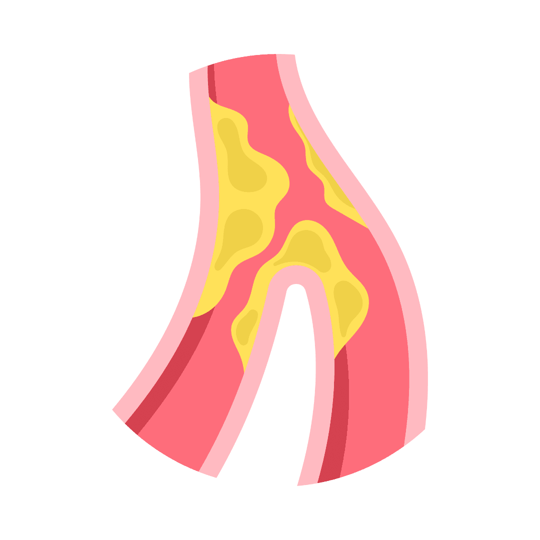  Atherosclerosis