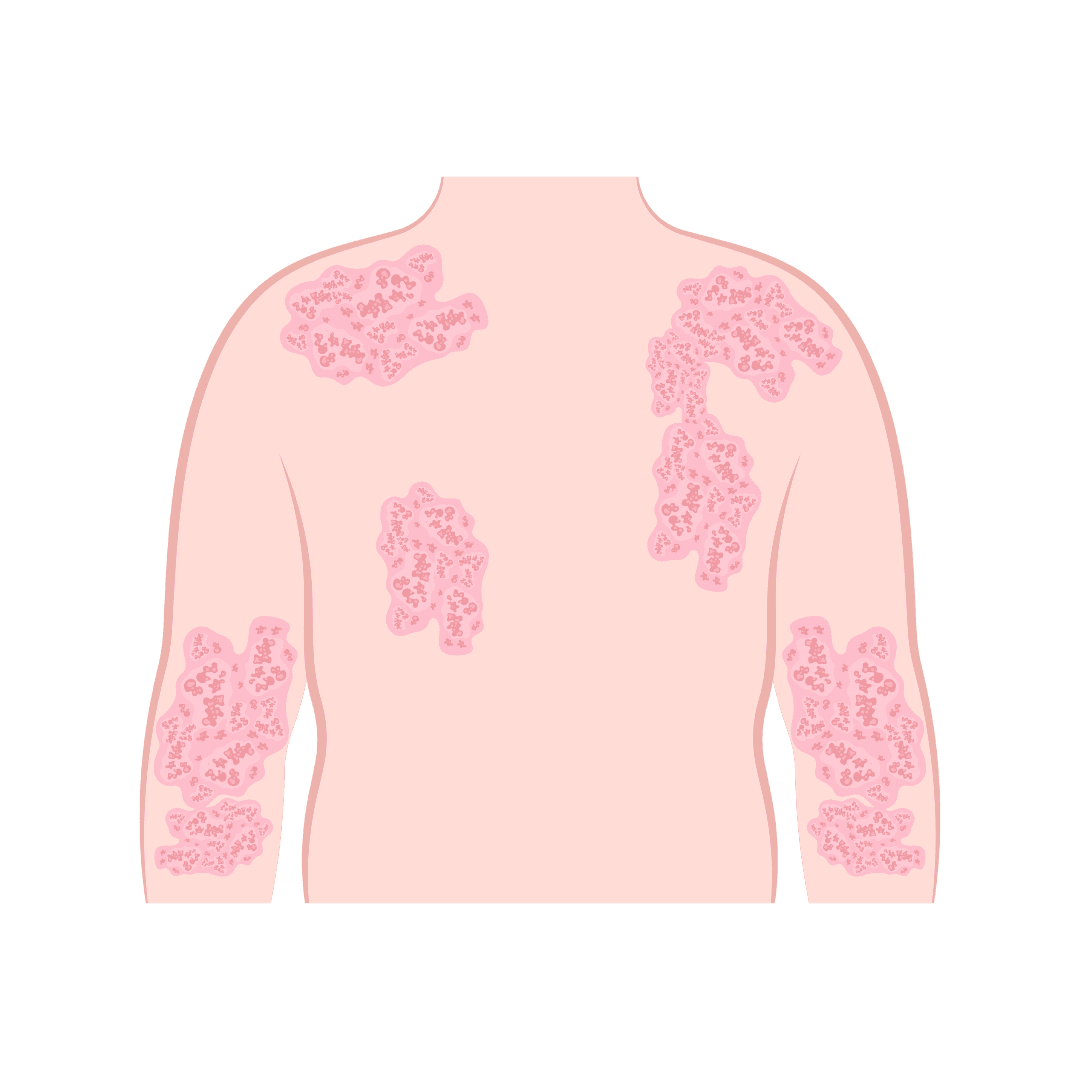 Atopic dermatitis and eczema