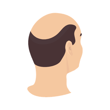 Alopecia and hair loss